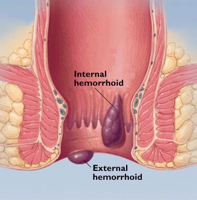 Hemoroidy